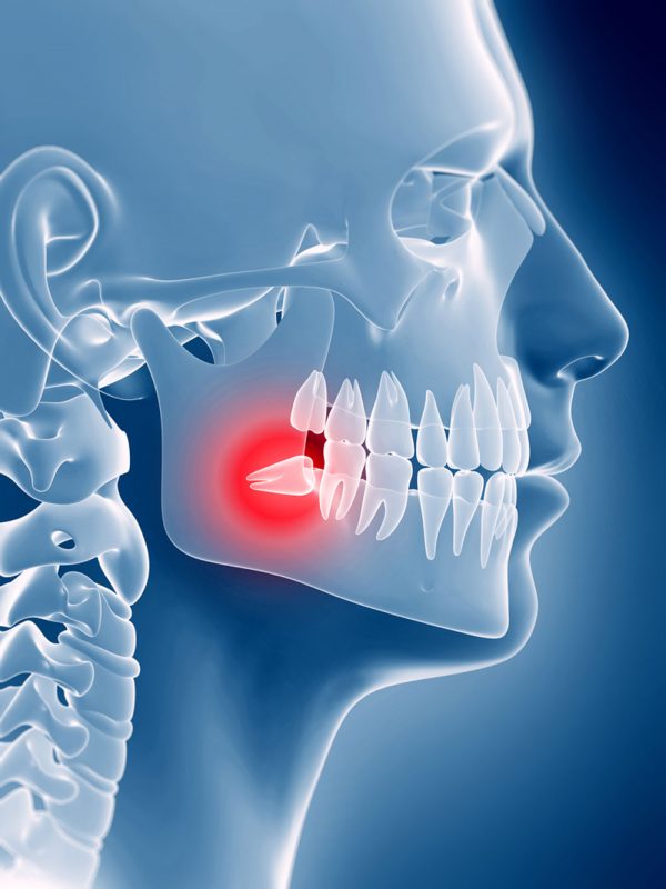 دندان عقل,کشیدن دندان عقل,ارتودنسی,ارتودنسی بدون جراحی دندان عقل,ارتودنسی بدون کشیدن دندان