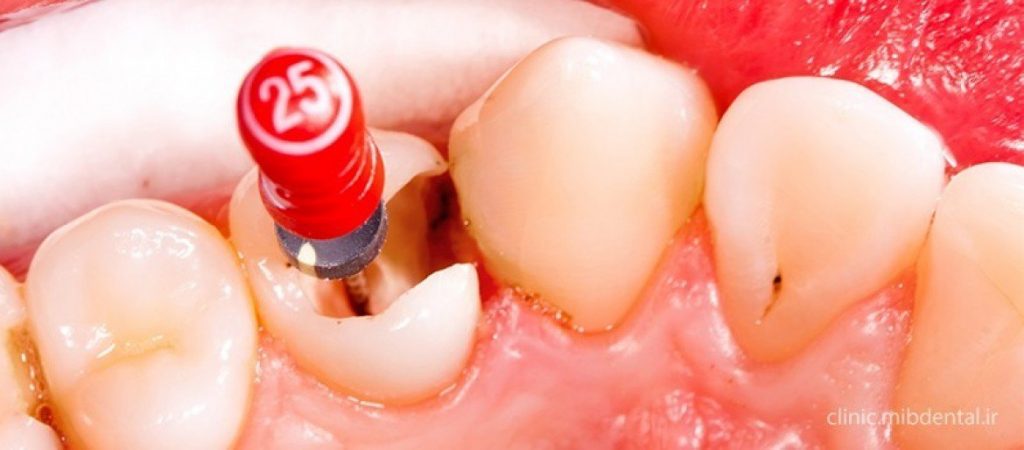 روکش دندان ، روکش برای عصب کشی دندان ، اندو ، دندانپزشکی غرب تهران ، سعادت اباد ، کیلینیک دندان پزشکی اوردنت