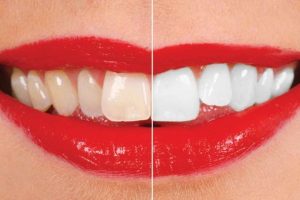 بیلیچینگ دندان سعادت آباد ، سفید کردن دندان سعادت ،سفید کردن دندان،دندانپزشکی سعادت آباد ، کلینیک اوردنت ،